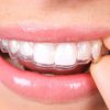 Преимущества трейнеров для зубов
