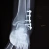 Новый имплантат исцеляет сломанные ноги, превращаясь в настоящую кость