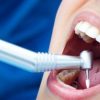 Новые зубные пломбы теперь будут служить в два раза дольше, чем ныне существующие